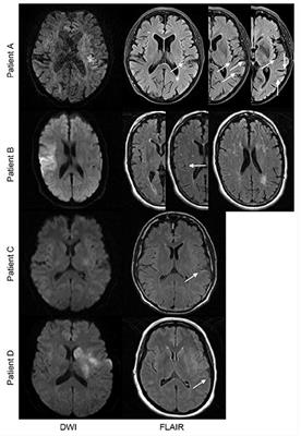 Extent of FLAIR Hyperintense Vessels May Modify Treatment Effect of Thrombolysis: A Post hoc Analysis of the WAKE-UP Trial